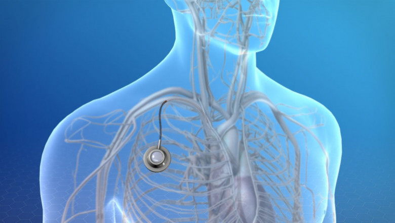 Totally Implantable Access Port Market Insight | Outlook | Growth Analysis Report 2022-2028