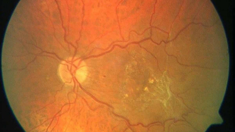 Global Macular Degeneration Treatment Market Recent Developments, 2022-2028