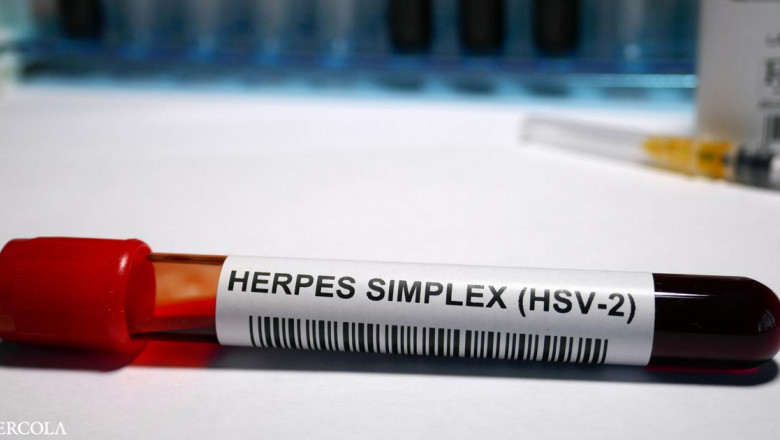 What are the Herpes Simplex Virus (HSV) Vaccines?
