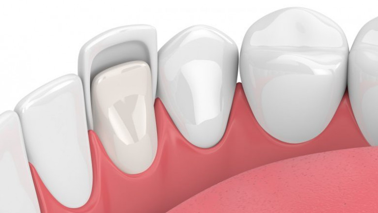 Creating Beautiful Smiles With Porcelain Veneers