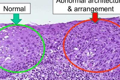 Global Cervical Dysplasia Market: Share, Size, Growth, Opportunity and Forecast 2020-2027
