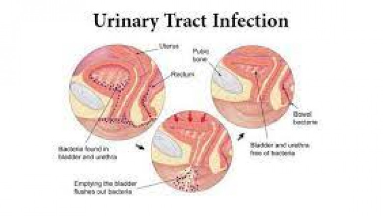 Global Urinary Tract Infection Treatment Market Report, Latest Trends, Industry Opportunity & Forecast to 2028