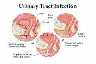 Global Urinary Tract Infection Treatment Market Report, Latest Trends, Industry Opportunity & Forecast to 2028