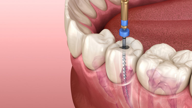 How Long Does It Take Wisdom Teeth Removal To Recover?
