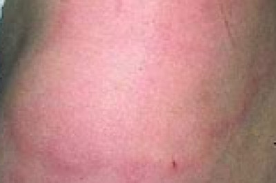 Leprosy Treatment Market 2022 | Industry Demand, Fastest Growth, Opportunities Analysis and Forecast To 2028