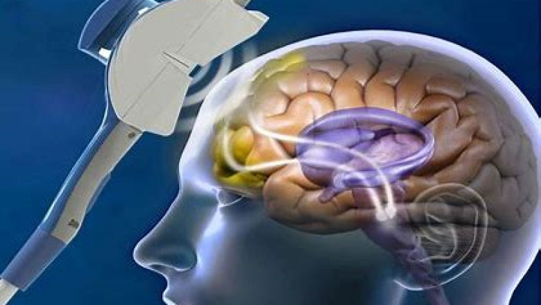 Transcranial Electrical Stimulators Market Competitive Landscape and its Industry Growth Prospect By 2028