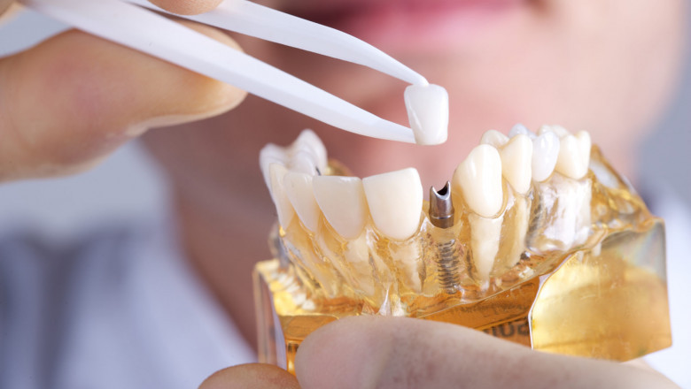 A Dental Implant Is An Alloplastic Structure That Is Implanted Beneath The Mucosa And/Or Periosteum