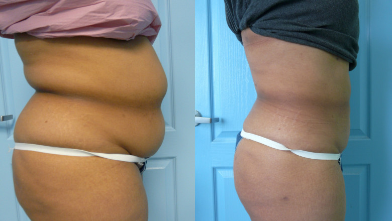 Best Liposuction Surgery in Delhi at Our Clinic