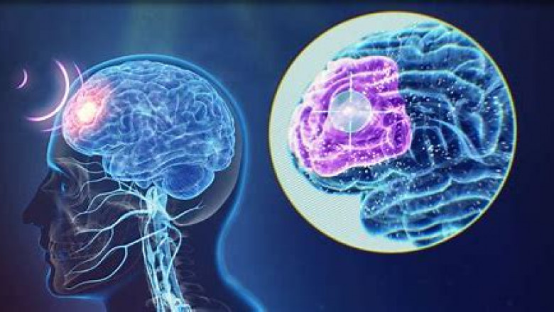 Transcranial Magnetic Stimulator Market 2022 New Opportunities, Dynamics With Financial Facts By 2028