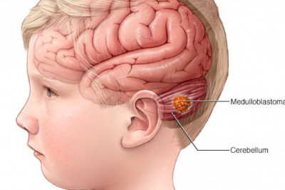 Glioblastoma Multiforme Treatment Market Global Industry Analysis and Forecast 2021-2027