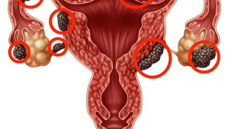 Endometriosis Market Share, Price, Trends Analysis By 2029