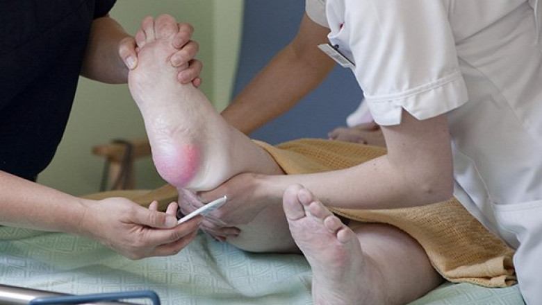How Does Hypertension Affect Pressure Ulcers?