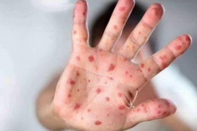 What is Tomato Flu? Early Symptoms & Preventive