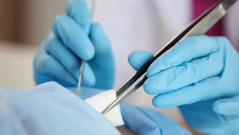 Hpv Warts Removal Treatment In Malaysia – Get Treated By The Best Doctors