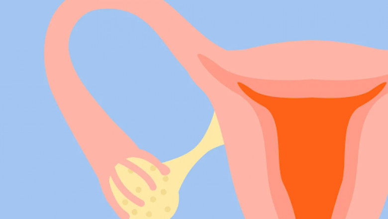 Poor Ovarian Reserve and Infertility – What Need to Know