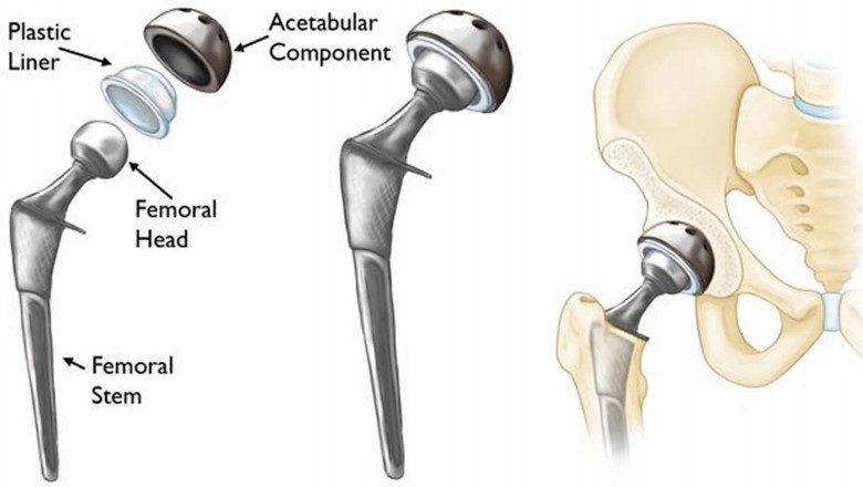 What are the Risks of Hip Implants?