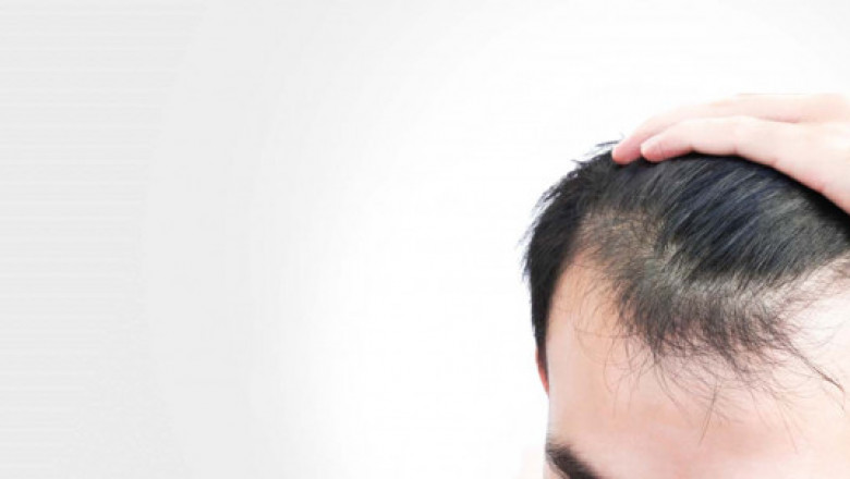Get Radiant Looking Hair With Hair Transplant In Mumbai