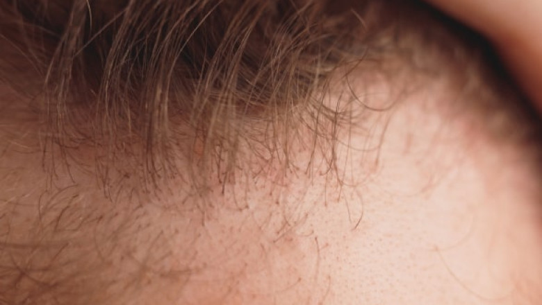 Get The Best Hair Transplant in Dwarka at Skin Decor