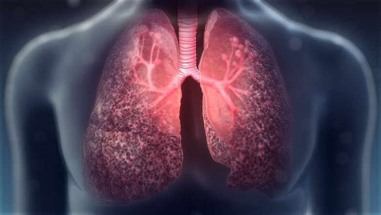 Global Cystic Fibrosis Market Outlook
