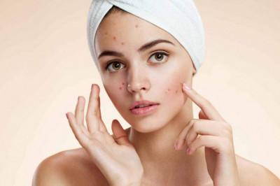Increasing Prevalence of Global Acne Vulgaris Treatment Market, Forecast Analysis 2022-2028
