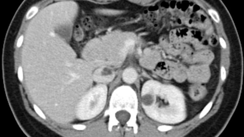 Angiomyolipoma Market Size, Share, Trends & Forecast 2029