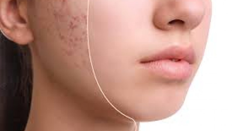 Global Glycolic Acid Market 2022 - Top Key Players Analysis Report Till 2028