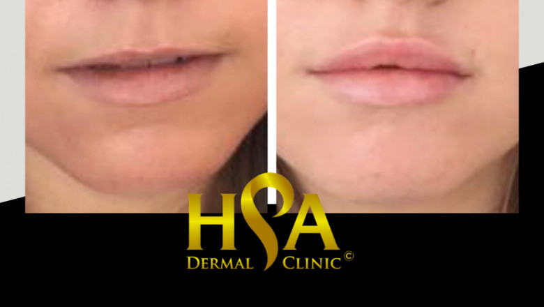 Lip Augmentation in London through Dermal Fillers- Enhance the Appearance
