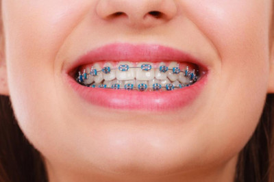 Market size, share, growth, opportunity, and trends in the dental braces market