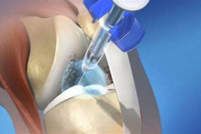 Viscosupplementation Market 2022 | Industry Demand, Fastest Growth, Opportunities Analysis and Forecast To 2028