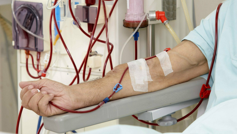 Hemodialysis Involves Pumping Blood Out Of Blood Vessels, Purifying It With A Dialyzer