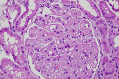 Idiopathic Membranous Nephropathy Treatment include damaged or thickened small blood vessels in the kidney (glomeruli), which filter wastes from the blood.