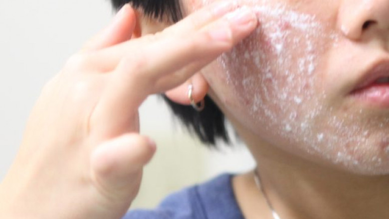 Things to know about Salicylic Acid