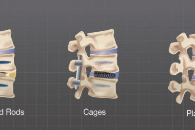 Anatomical Surgical Defects Of The Spine Can Be Corrected Using Spinal Non-Fusion Device