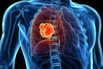 Lung Cancer Therapeutics Market Share and Growth Factors 2021–2027