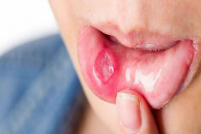 Mouth Ulcer Treatment Market In-Depth Analysis & Forecast 2019-2030