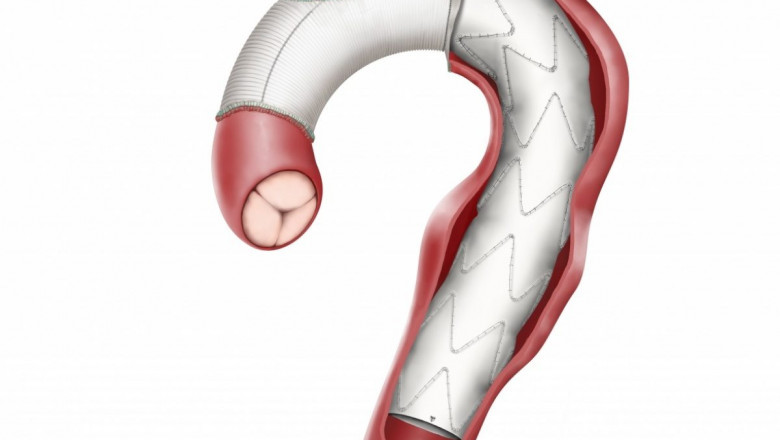Aorta Vascular Prosthesis Market Growth Statistics, Size Estimation, Emerging Trends, Outlook to 2030
