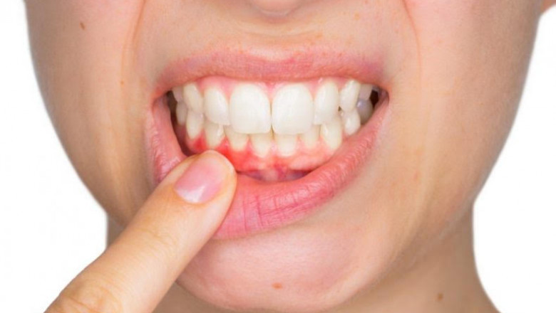 How To Keep Your Gums Healthy?