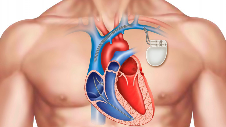 A cardiac pacemaker is a tiny device that is placed in the chest to regulate the sluggish heartbeat.