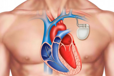 A cardiac pacemaker is a tiny device that is placed in the chest to regulate the sluggish heartbeat.
