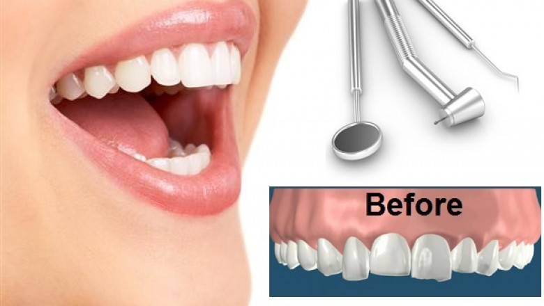 Global Dental Contouring Market Report, Latest Trends, Industry Opportunity & Forecast to 2028