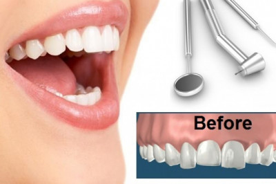 Global Dental Contouring Market Report, Latest Trends, Industry Opportunity & Forecast to 2028
