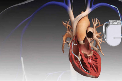 Global Implantable Cardioverter-defibrillators Market Restraints