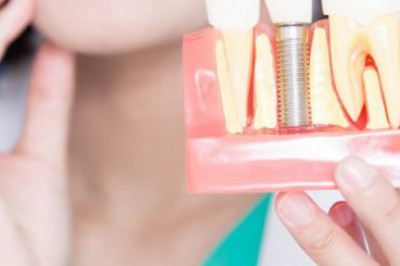 Why Dental Implants Prove To Be The Best Replacement Option For Missing Tooth?