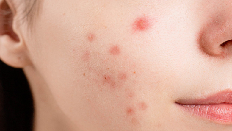Best Acne Treatment in Utah - Revere Health