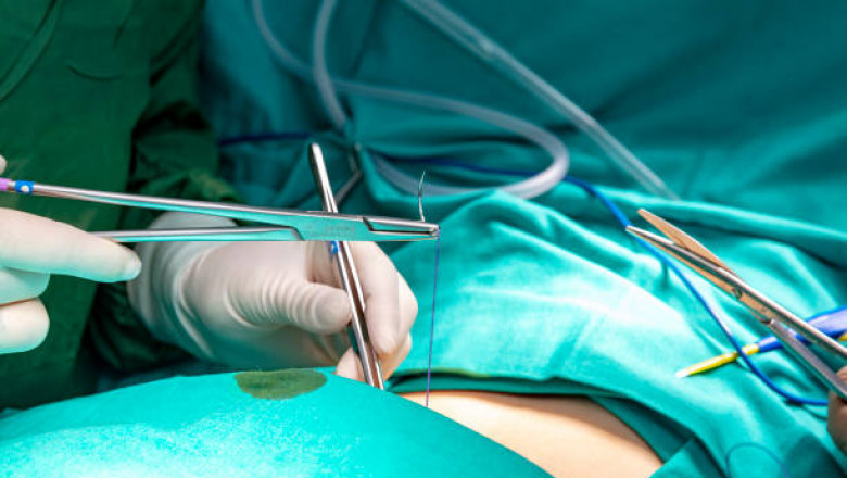 In Orthopaedic Surgery Or In The Closure Of Open Wounds, Surgical Sutures Are Used To Tie Blood Vessels During Or After Surgery