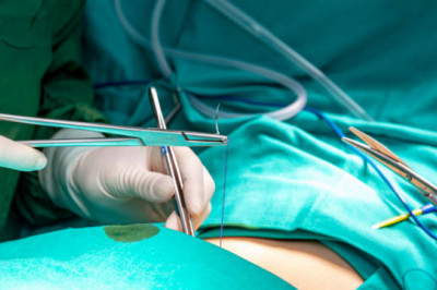 In Orthopaedic Surgery Or In The Closure Of Open Wounds, Surgical Sutures Are Used To Tie Blood Vessels During Or After Surgery