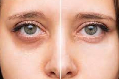 Dark Under Eyes Treatment San Diego