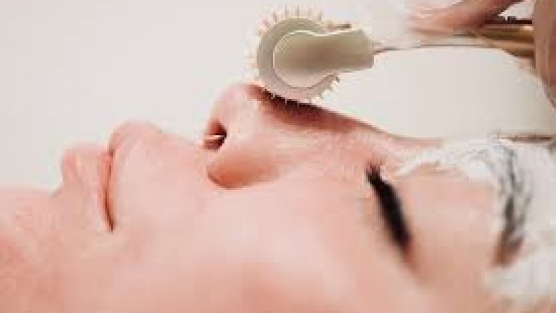 Vampire Facial Treatment in San Diego