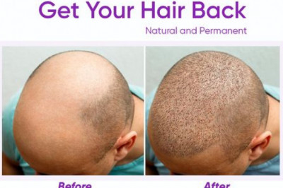 Superior Quality Hair Transplant Services Keeping Your safety at Priority