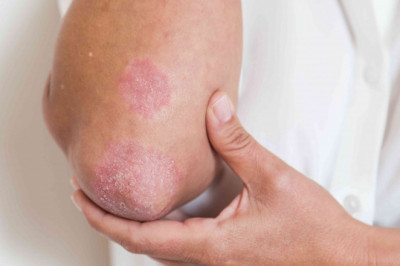 Actinic Keratosis Market: A Deep Dive Analysis Of Various Regions And Strategies During Forecast Period 2021 – 2028